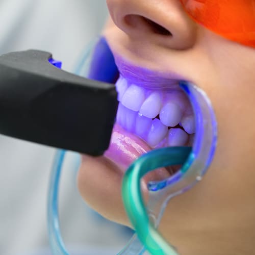Teeth Whitening Service