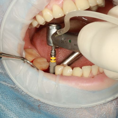 Dental Implants