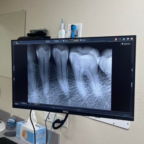 Root Canals