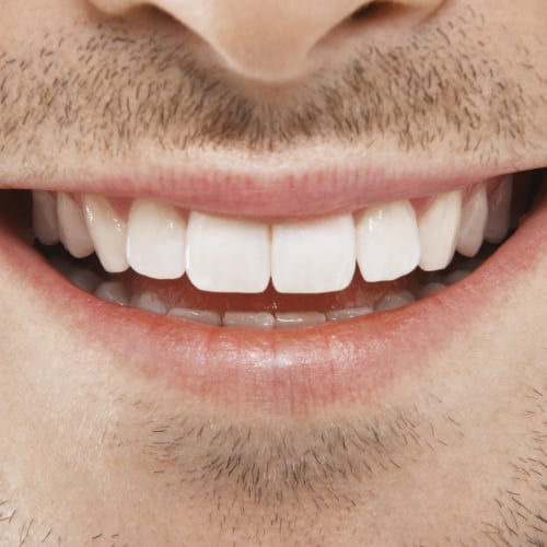 Teeth Cleaning