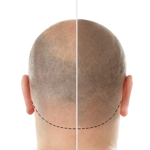 Micropigmentation
