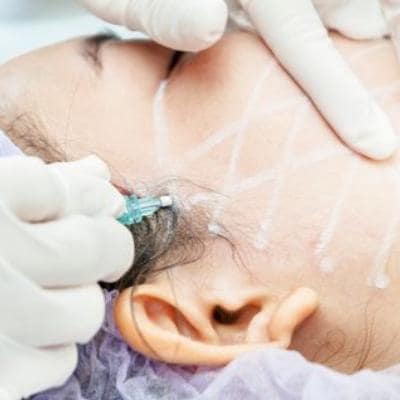 PDO FACE THREAD LIFT