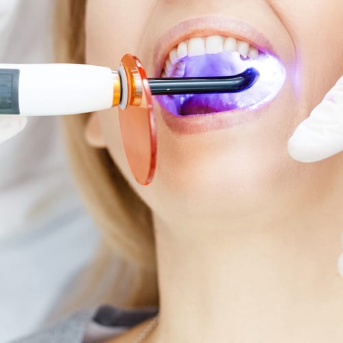 Teeth Whitening