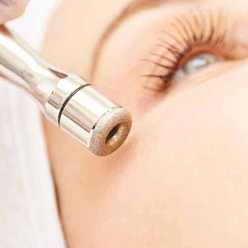 Microdermabrasion