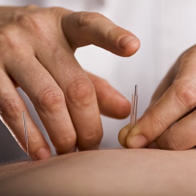 ACUPUNCTURE