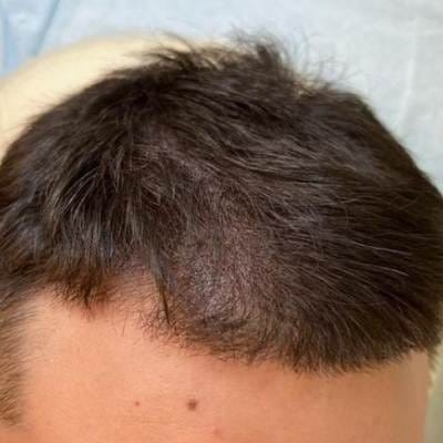 MICROPIGMENTATION