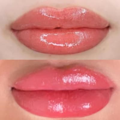 LIP FILLERS