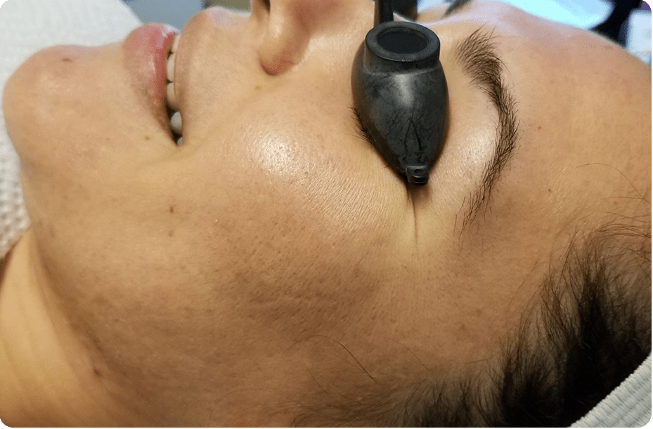 Scar Removal Services