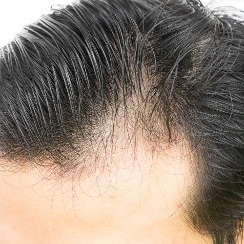 Thinning Hair Treatment