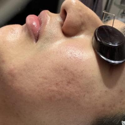 CHEMICAL EXFOLIATION