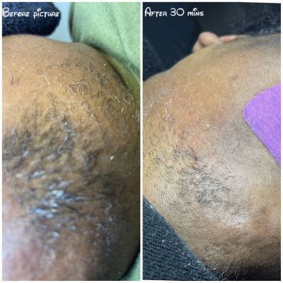 ELECTROLYSIS HAIR REMOVAL SERVICE