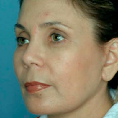 FACELIFT SURGERY