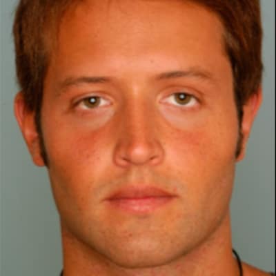 FACIAL IMPLANTS