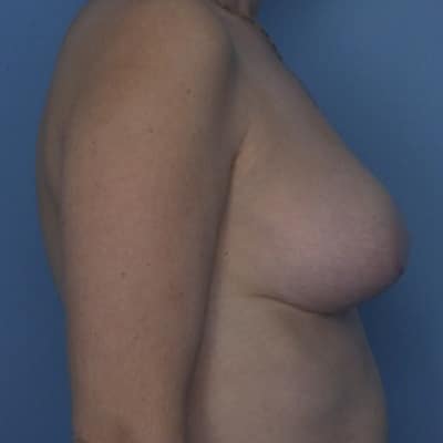 BREAST LIFT