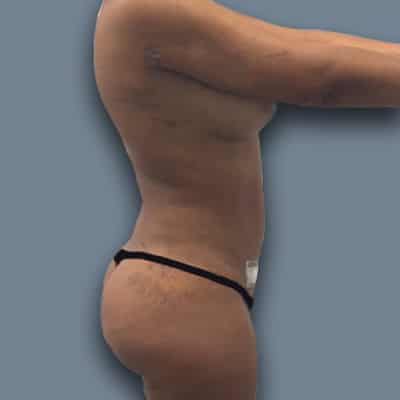 LIPOSUCTION