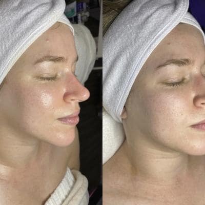 HYDRAFACIALS