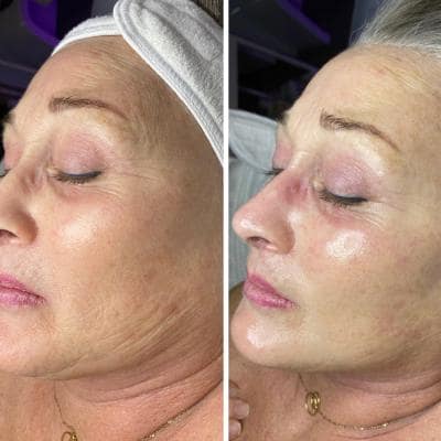 MICRODERMABRASION FACIALS