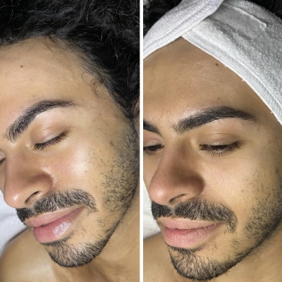 MICRONEEDLING