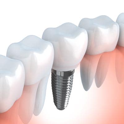 Dental Implants