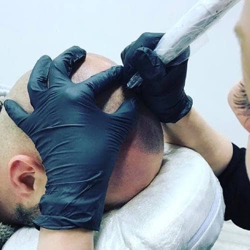 Scalp Micropigmentation