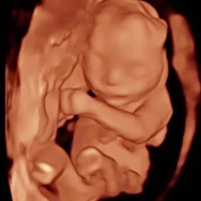 3D ULTRASOUND 