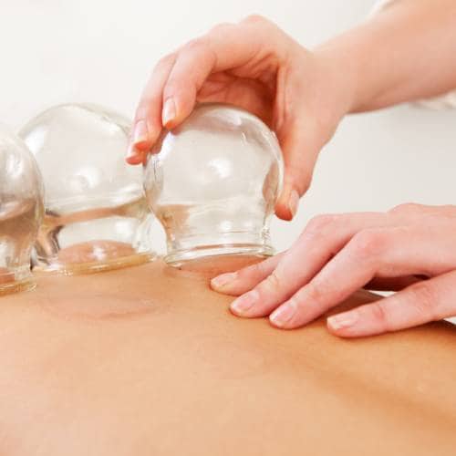 Cupping Therapy