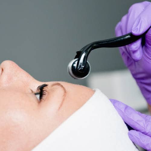 Microneedling