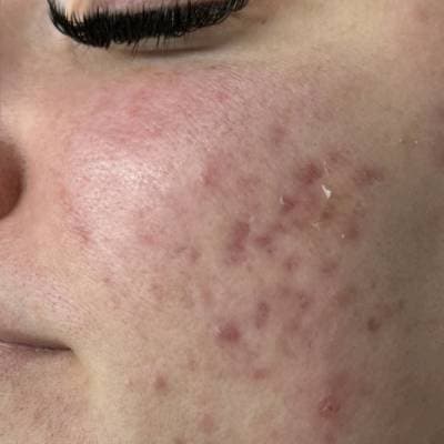 MICRODERMABRASION