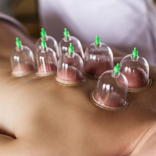 Cupping Therapy