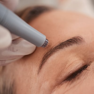 RF MICROBLADING