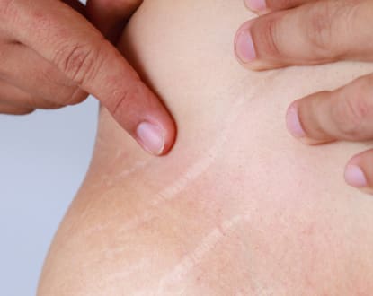 SCAR & STRETCHMARK CAMOUFLAGE