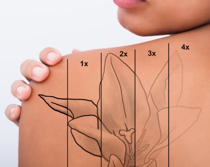 TATTOO REMOVAL