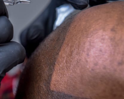 SCALP PIGMENTATION
