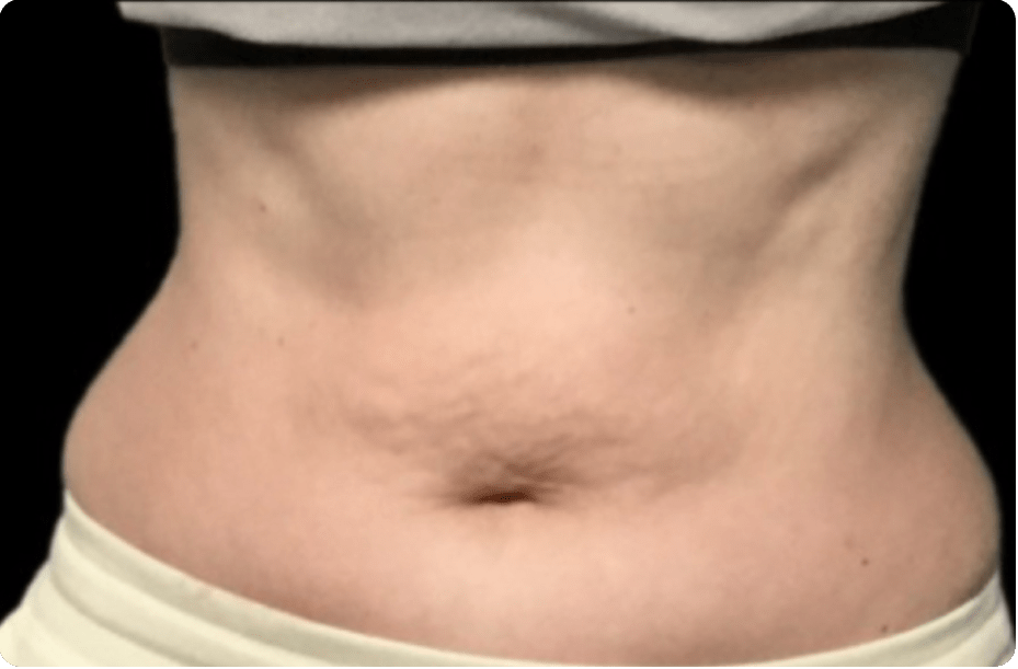 Tummy Tuck
