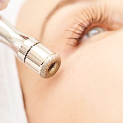 Microdermabrasion