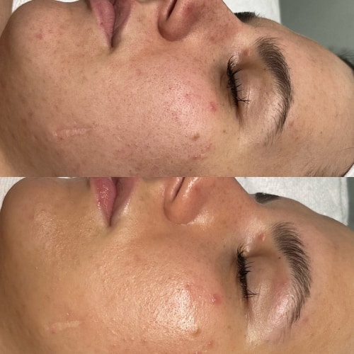Anti-Acne Facials