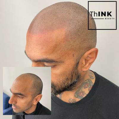 SCALP MICROPIGMENTATION CONSULTATION