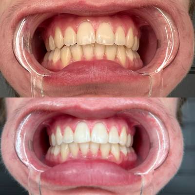 TEETH WHITENING