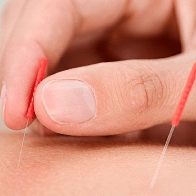 ACUPUNCTURE