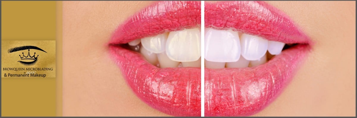 Teeth Whitening Service