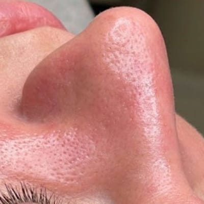 DEEP PORE CLEANSING FACIAL