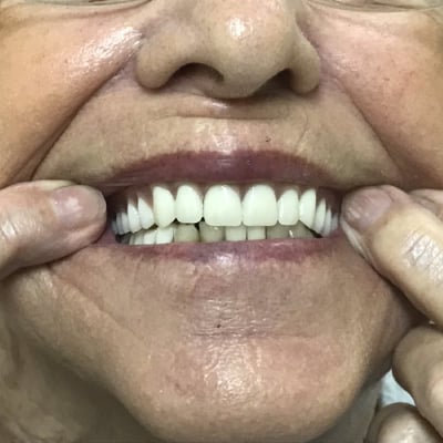 DENTURES