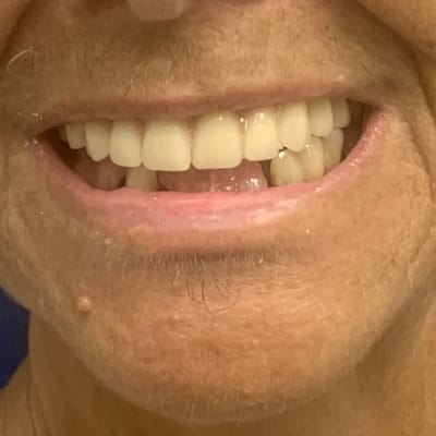 DENTURE REPAIR