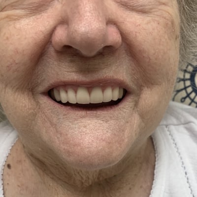 DENTURE IMPLANTS