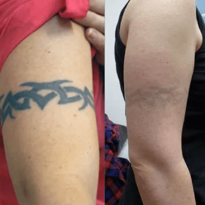 TATTOO REMOVAL