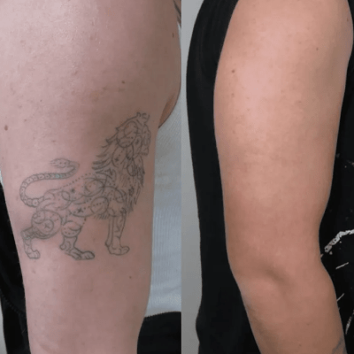 PICO LASER TATTOO REMOVAL