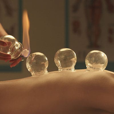 Fire Cupping