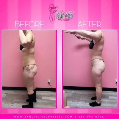 Cavitation Treatment
