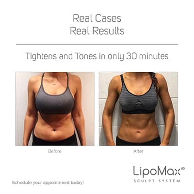BODY SCULPTING