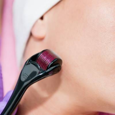 MICRONEEDLING